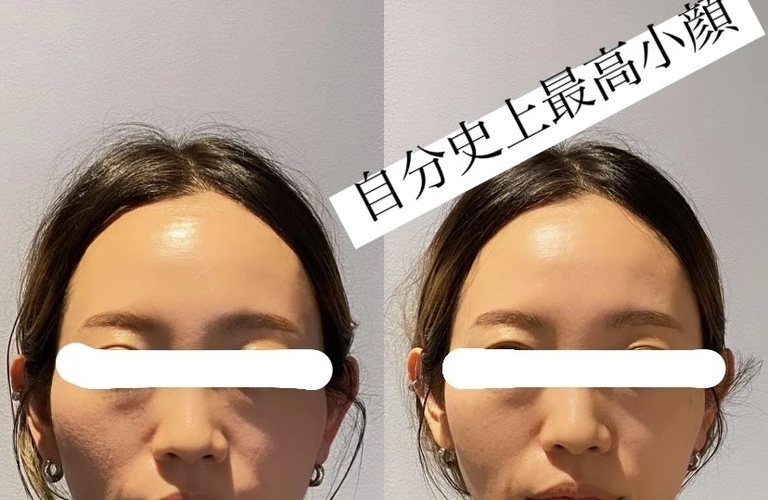 名東区で理想の小顔を手に入れる新しいアプローチ